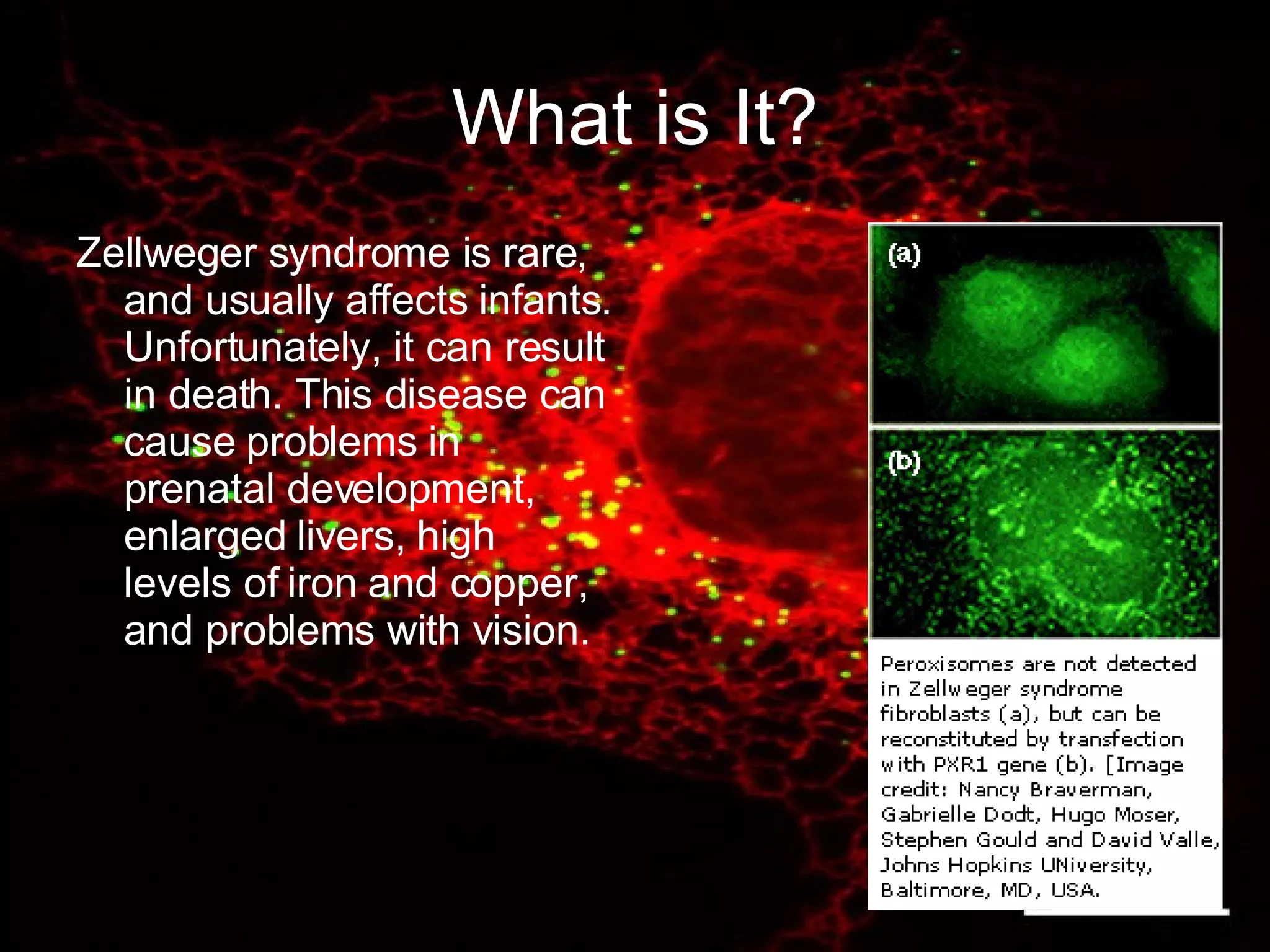 Zellweger Syndrome | PPT
