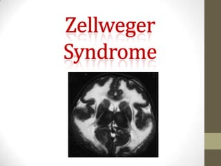 zellweger-syndrome-pptx