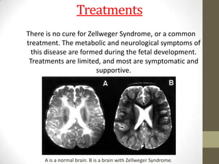 zellweger-syndrome-pptx