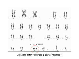 Gizonezko baten kariotipoa ( Down sindromea ) 21.en  trisomia 