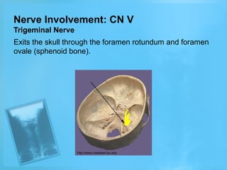 Nerve Involvement: CN V
Trigeminal Nerve
Exits the skull through the foramen rotundum and foramen
ovale (sphenoid bone).

http://www.meddean.luc.edu

 
