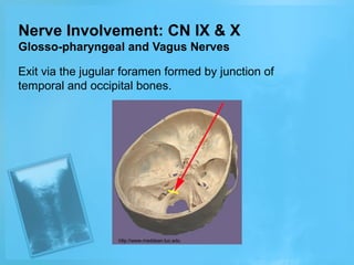 Nerve Involvement: CN IX & X
Glosso-pharyngeal and Vagus Nerves
Exit via the jugular foramen formed by junction of
temporal and occipital bones.

http://www.meddean.luc.edu

 