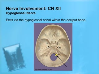 Nerve Involvement: CN XII
Hypoglossal Nerve
Exits via the hypoglossal canal within the occiput bone.

http://www.meddean.luc.edu

 