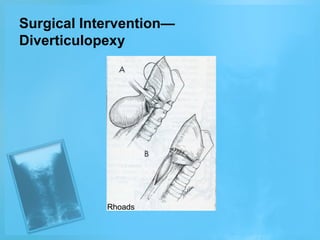Surgical Intervention—
Diverticulopexy

Rhoads

 