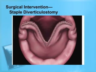 Surgical Intervention—
Staple Diverticulostomy

 