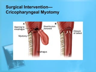 Surgical Intervention—
Cricopharyngeal Myotomy

 