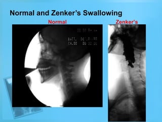 Normal and Zenker’s Swallowing
Normal

Zenker’s

 