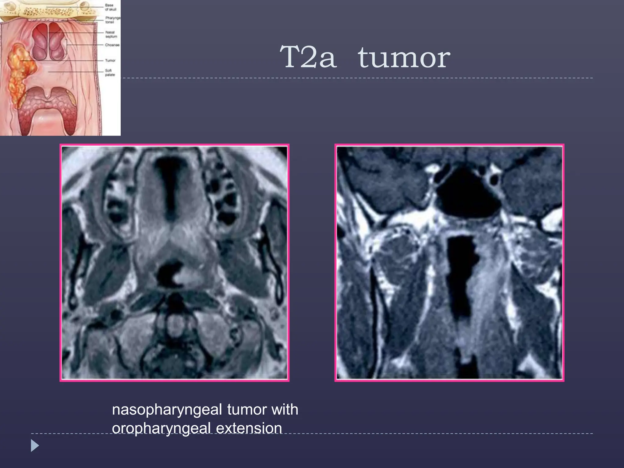 Nasopharyngeal carcinoma an importamnt cancer of nasopharynx | PPT ...