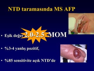 NTD taramasında MS AFP
• Eşik değer 2.0-2.5 MOM
• %3-4 yanlış pozitif,
• %85 sensitivite açık NTD’de
 