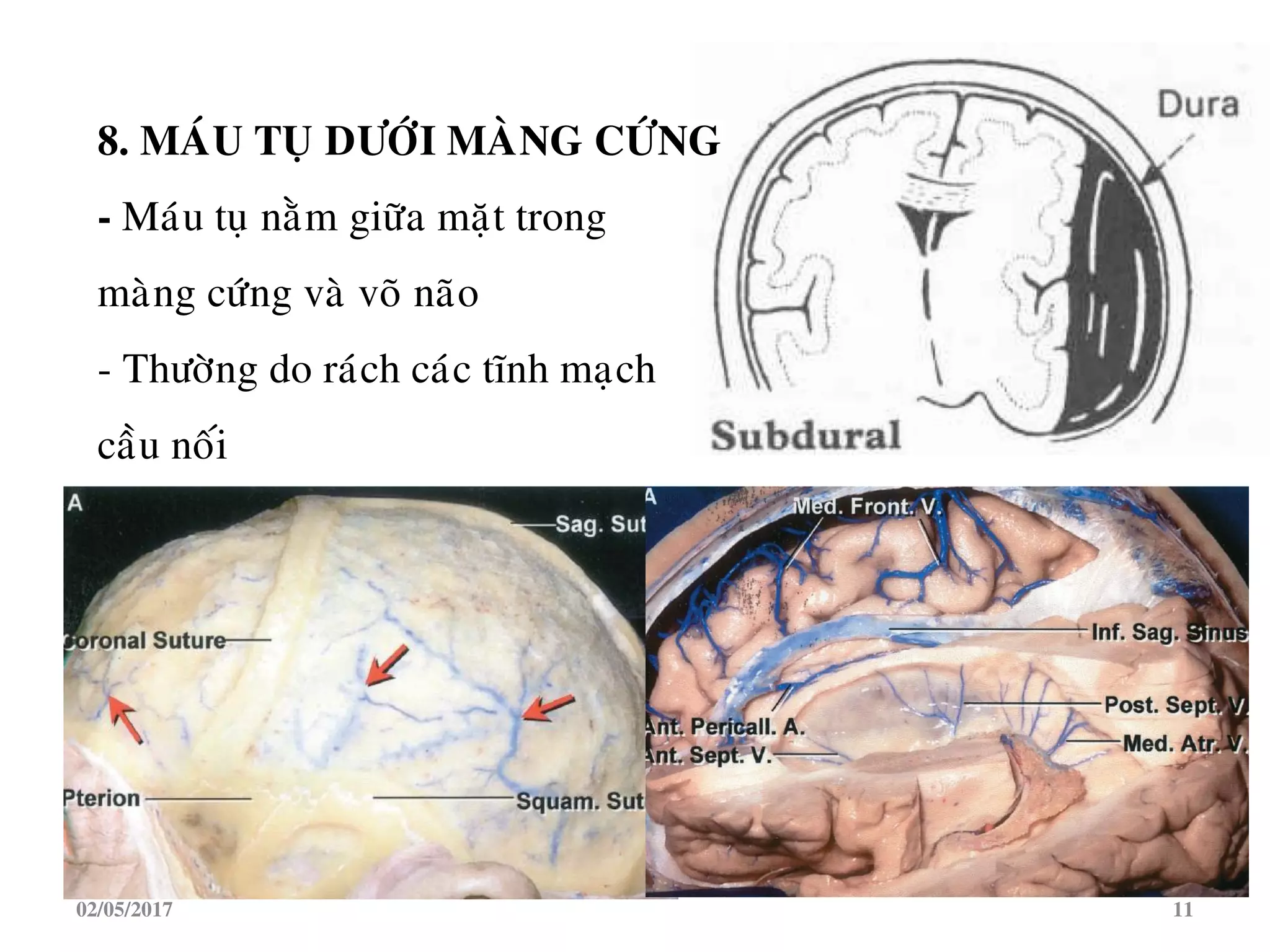 8. MAÙU TUÏ DÖÔÙI MAØNG CÖÙNG
- Maùu tuï naèm giöõa maët trong
maøng cöùng vaø voõ naõo
- Thöôøng do raùch caùc tónh maïch
caàu noái
02/05/2017 11
 
