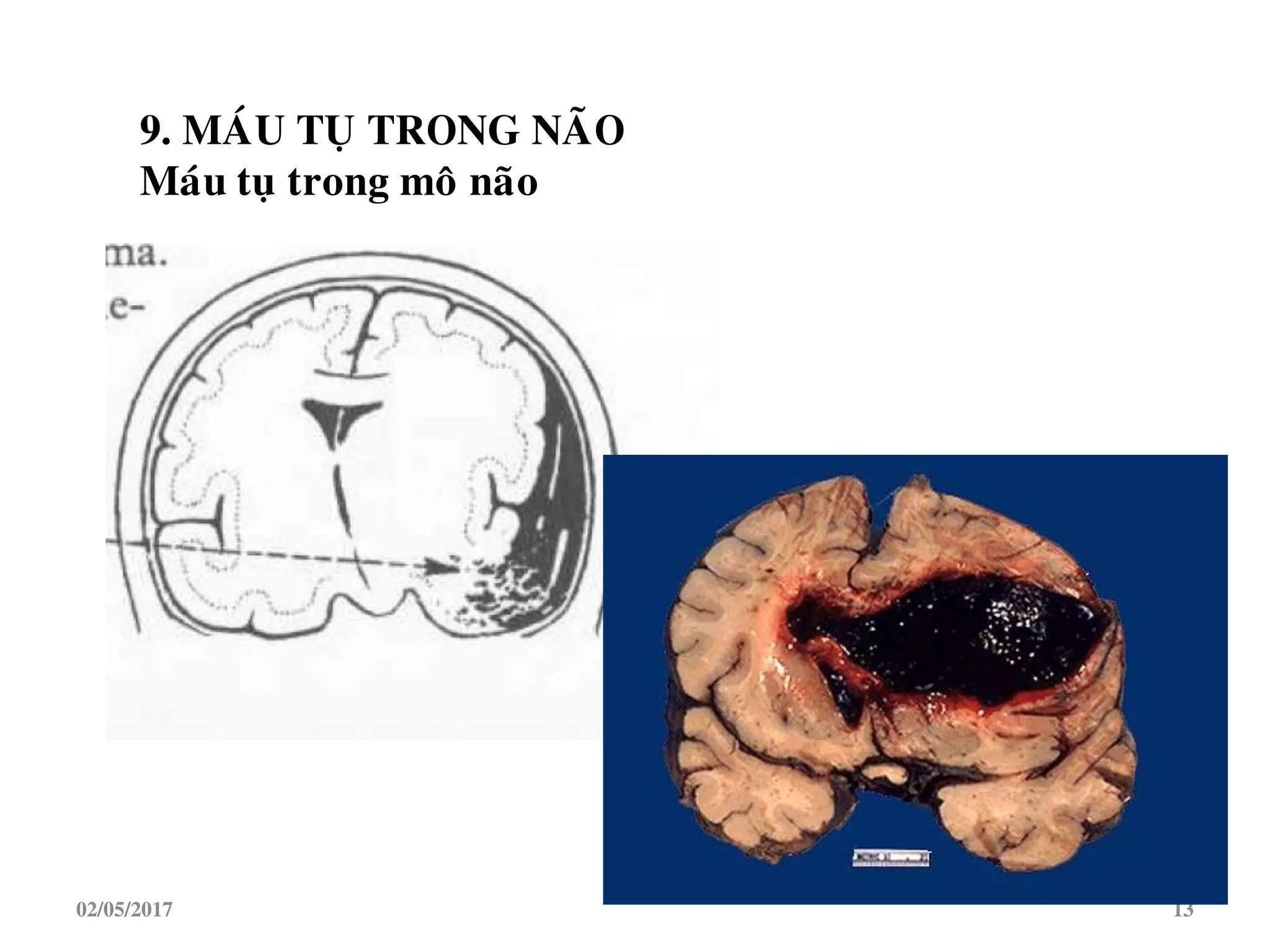 9. MAÙU TUÏ TRONG NAÕO
Maùu tuï trong moâ naõo
02/05/2017 13
 