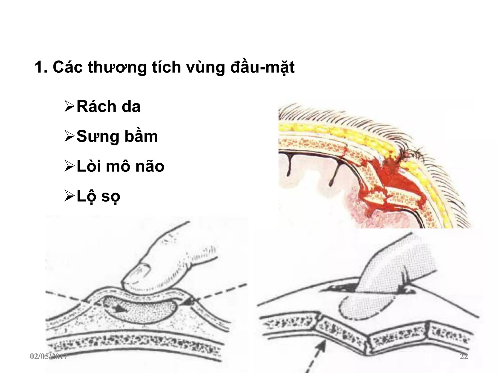 1. Các thƣơng tích vùng đầu-mặt
Rách da
Sƣng bầm
Lòi mô não
Lộ sọ
02/05/2017 22
 