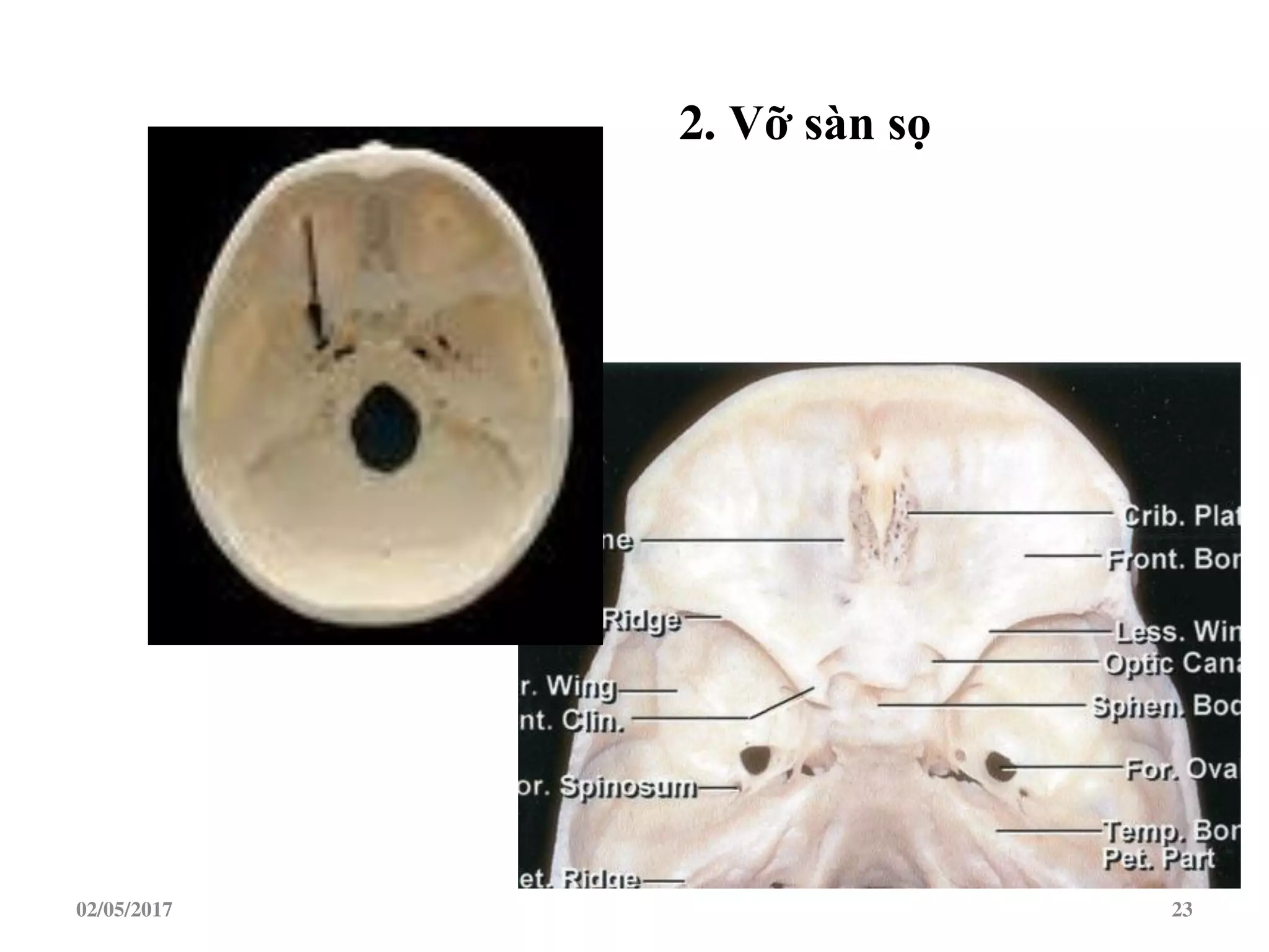 02/05/2017 23
2. Vỡ sàn sọ
 