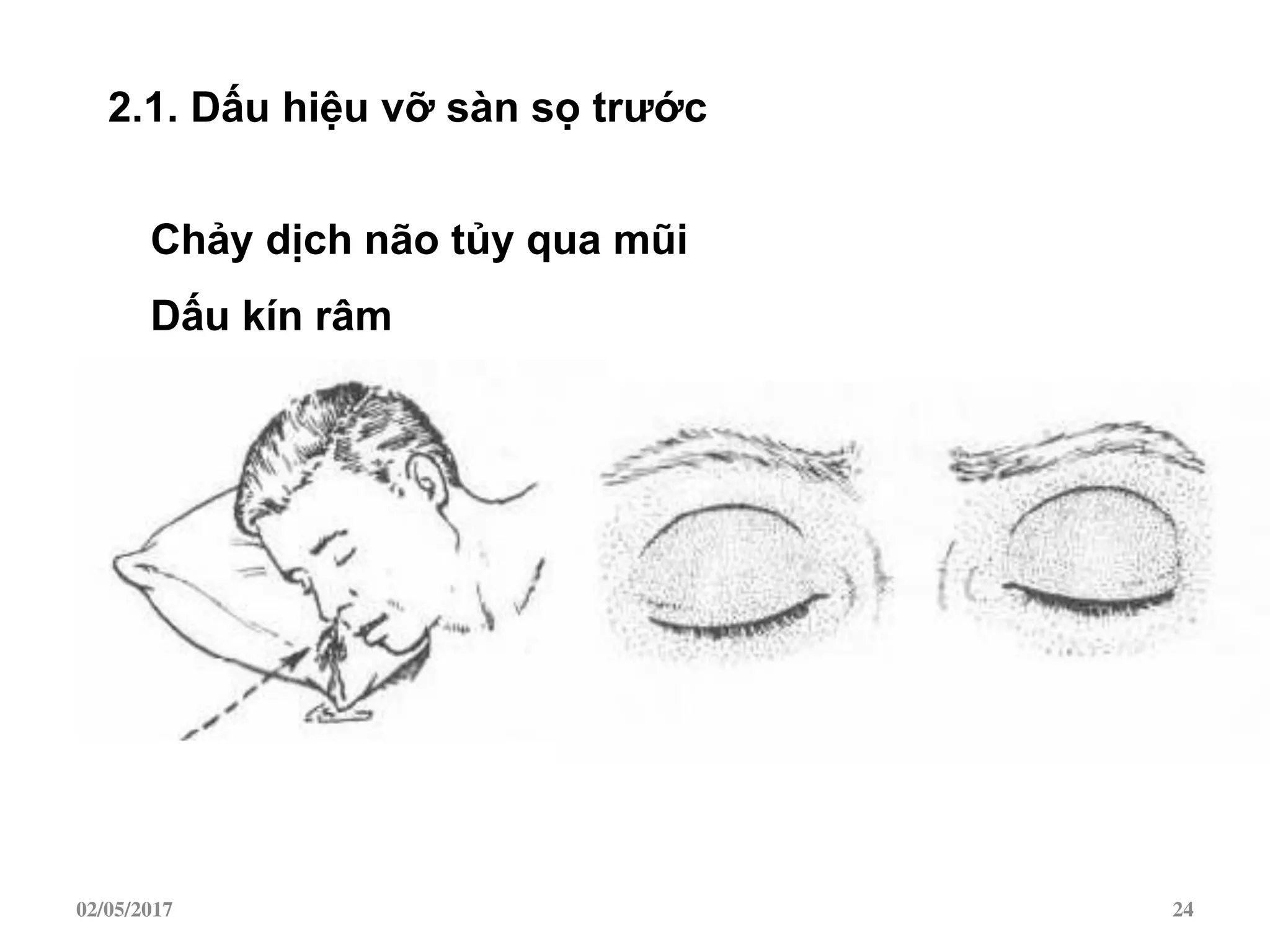 2.1. Dấu hiệu vỡ sàn sọ trƣớc
Chảy dịch não tủy qua mũi
Dấu kín râm
02/05/2017 24
 