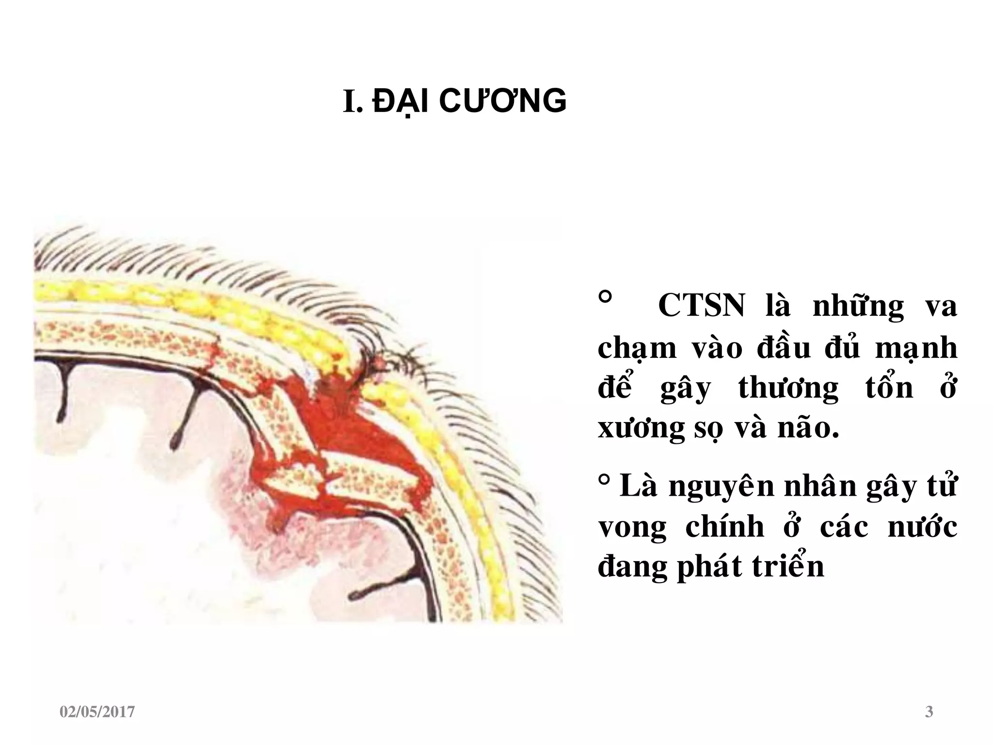 ° CTSN laø nhöõng va
chaïm vaøo ñaàu ñuû maïnh
ñeå gaây thöông toån ôû
xöông soï vaø naõo.
° Laø nguyeân nhaân gaây töû
vong chính ôû caùc nöôùc
ñang phaùt trieån
I. ĐẠI CƢƠNG
02/05/2017 3
 