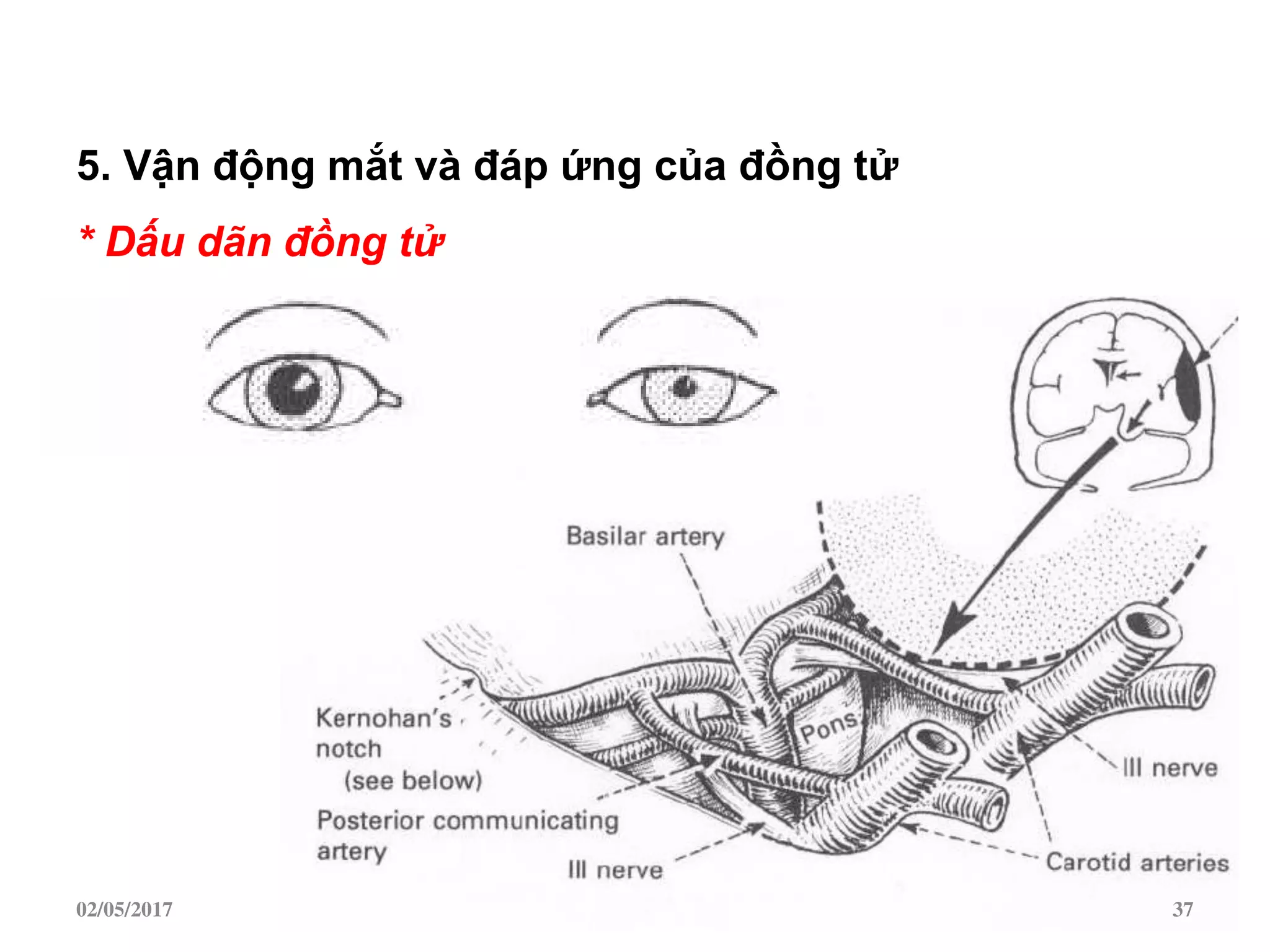 5. Vận động mắt và đáp ứng của đồng tử
* Dấu dãn đồng tử
02/05/2017 37
 