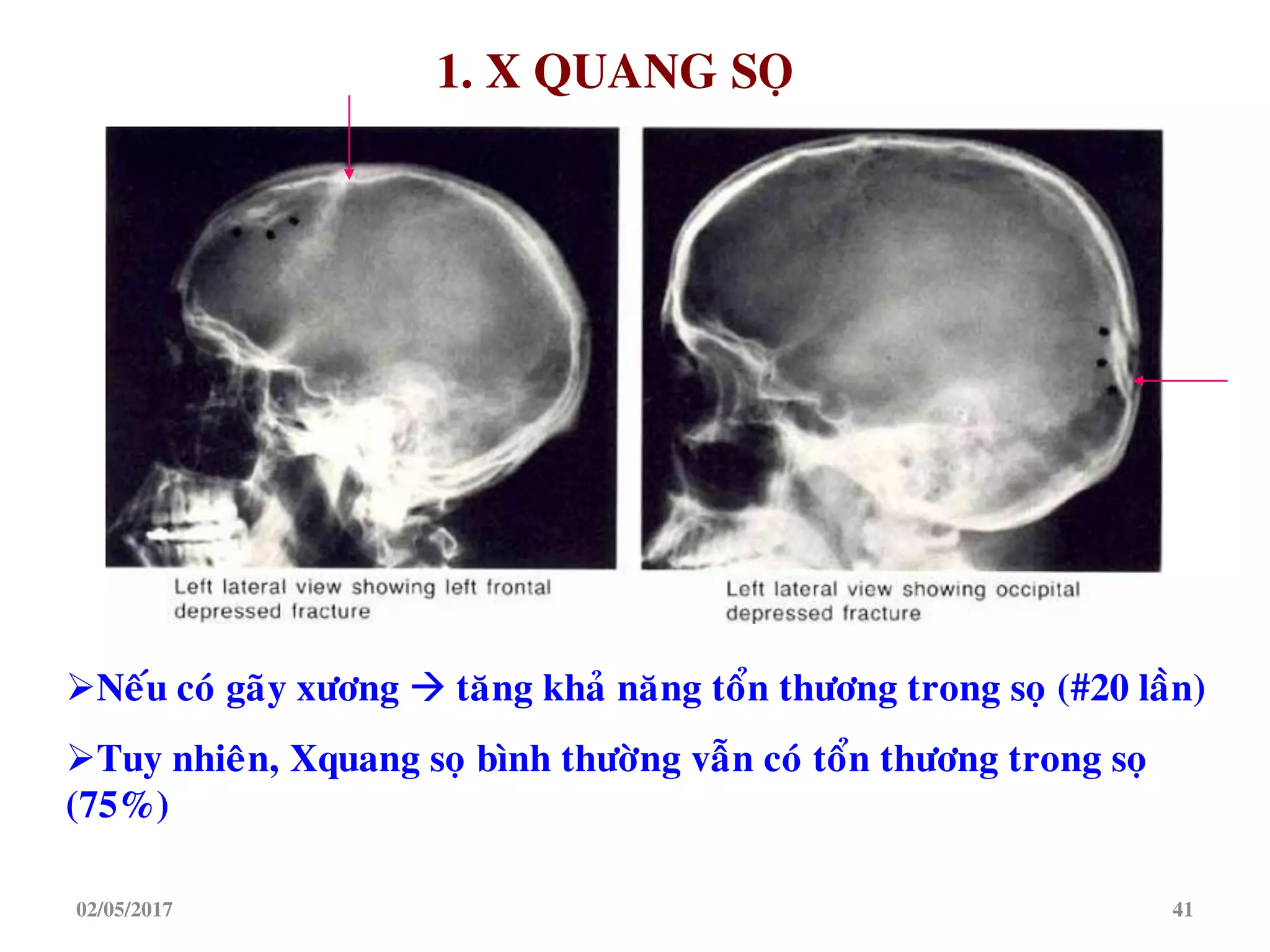 Neáu coù gaõy xöông  taêng khaû naêng toån thöông trong soï (#20 laàn)
Tuy nhieân, Xquang soï bình thöôøng vaãn coù toån thöông trong soï
(75%)
1. X QUANG SOÏ
02/05/2017 41
 