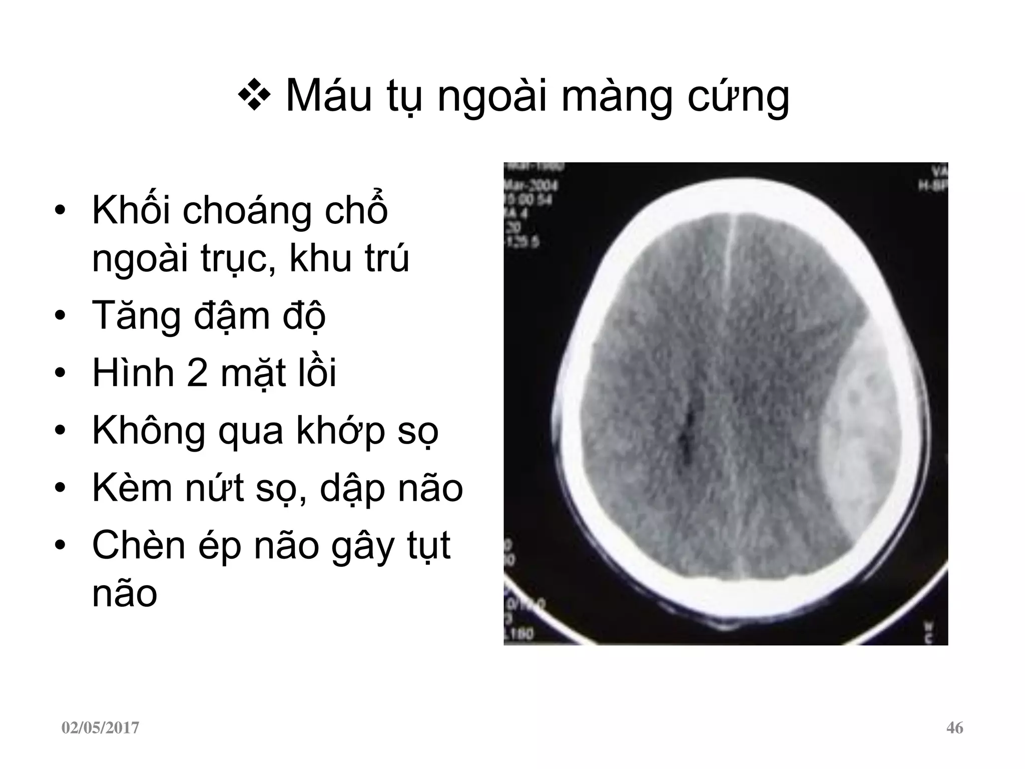  Máu tụ ngoài màng cứng
• Khối choáng chổ
ngoài trục, khu trú
• Tăng đậm độ
• Hình 2 mặt lồi
• Không qua khớp sọ
• Kèm nứt sọ, dập não
• Chèn ép não gây tụt
não
02/05/2017 46
 