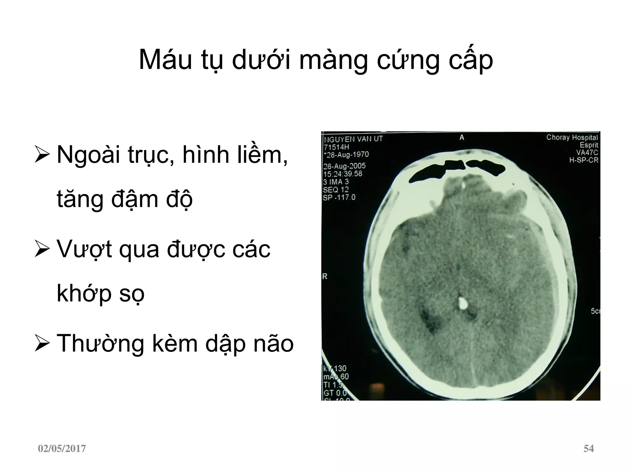 Máu tụ dưới màng cứng cấp
 Ngoài trục, hình liềm,
tăng đậm độ
 Vượt qua được các
khớp sọ
 Thường kèm dập não
02/05/2017 54
 