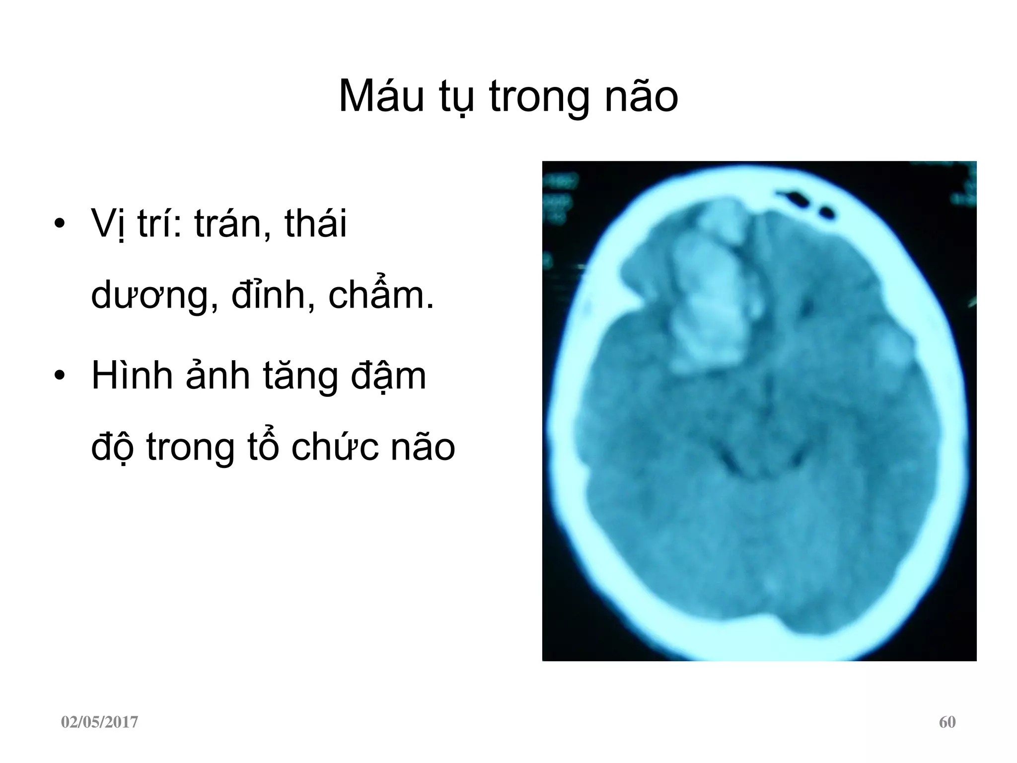 Máu tụ trong não
• Vị trí: trán, thái
dương, đỉnh, chẩm.
• Hình ảnh tăng đậm
độ trong tổ chức não
02/05/2017 60
 