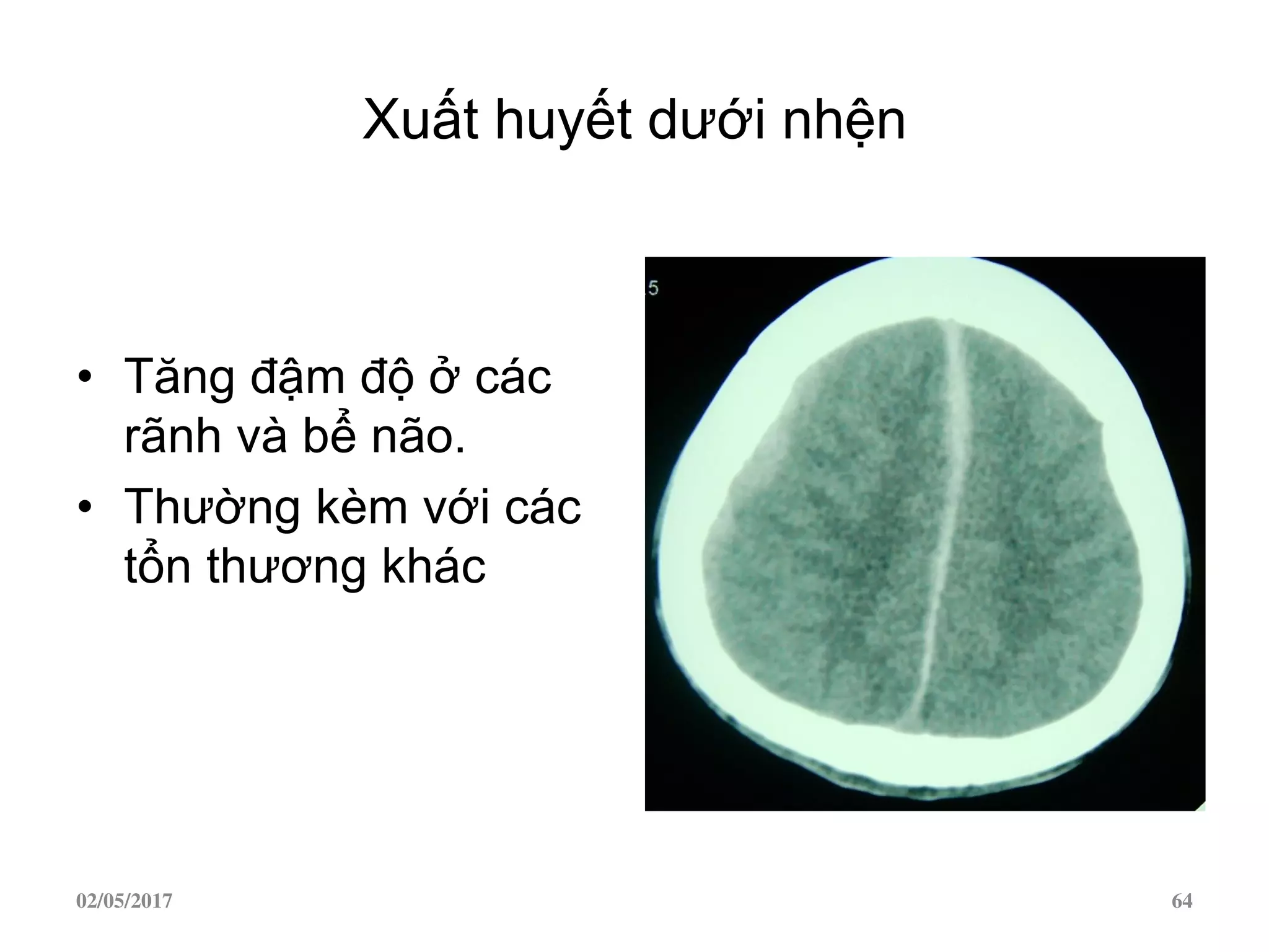 Xuất huyết dưới nhện
• Tăng đậm độ ở các
rãnh và bể não.
• Thường kèm với các
tổn thương khác
02/05/2017 64
 