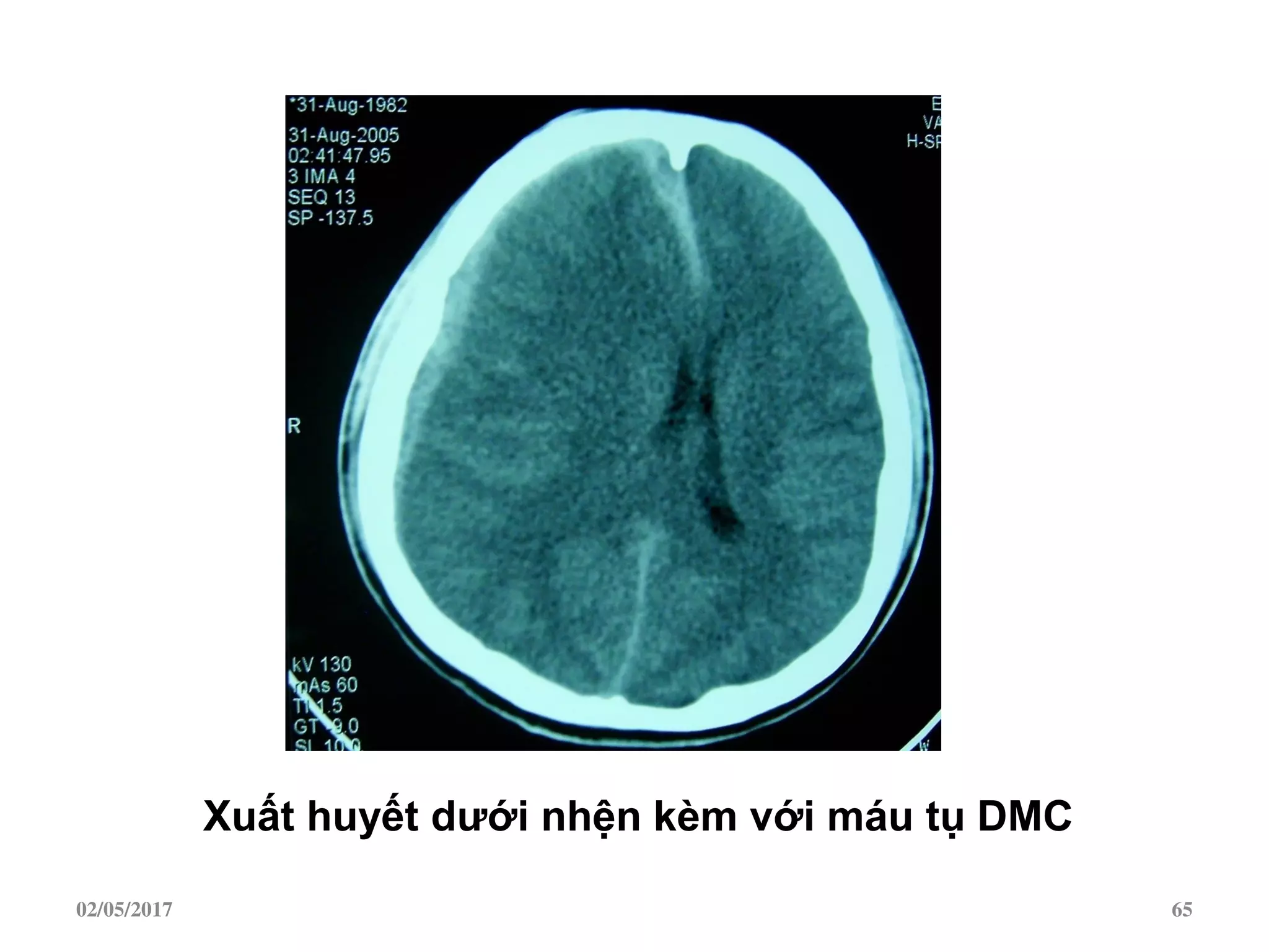 Xuất huyết dƣới nhện kèm với máu tụ DMC
02/05/2017 65
 