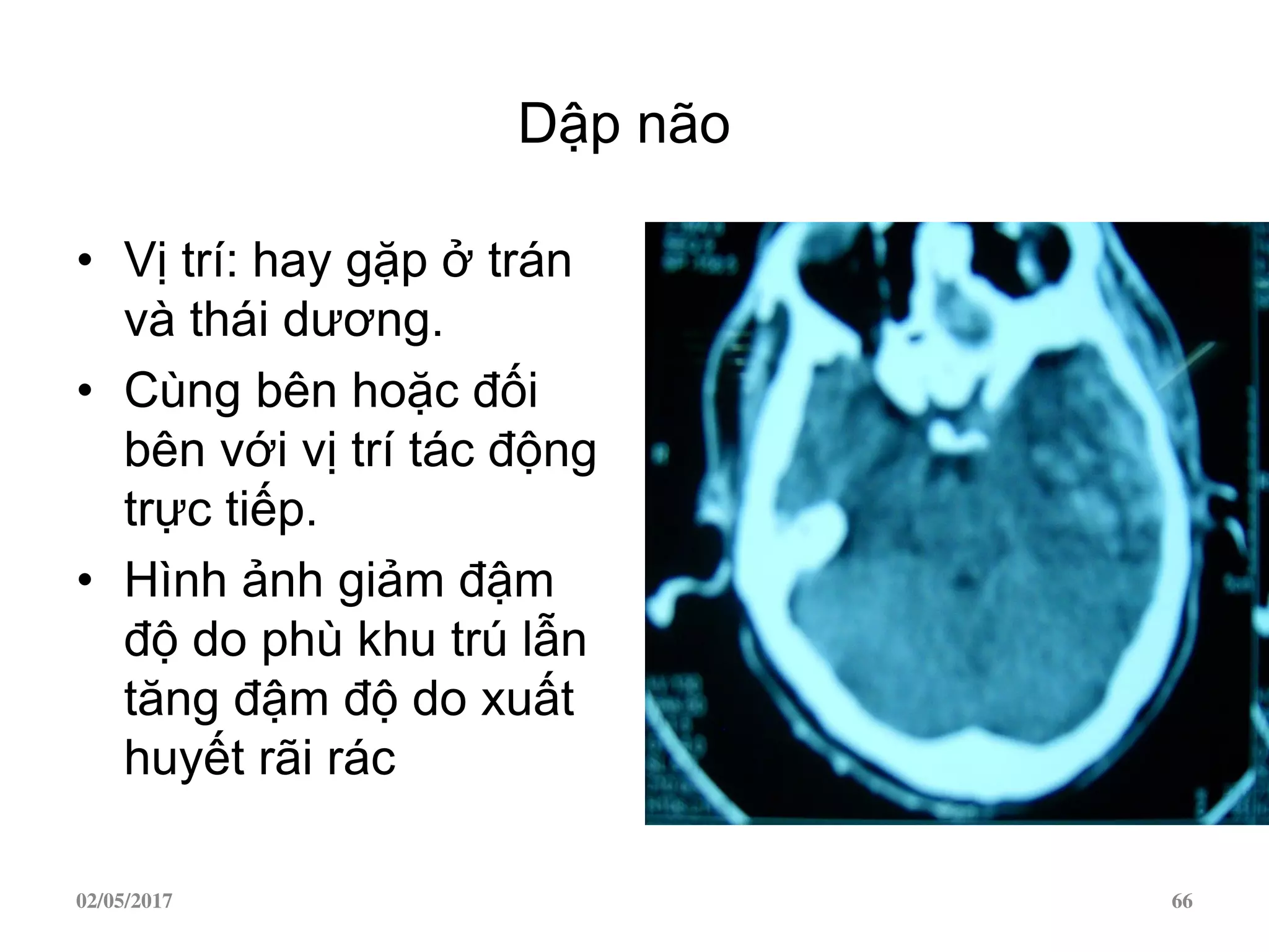 Dập não
• Vị trí: hay gặp ở trán
và thái dương.
• Cùng bên hoặc đối
bên với vị trí tác động
trực tiếp.
• Hình ảnh giảm đậm
độ do phù khu trú lẫn
tăng đậm độ do xuất
huyết rãi rác
02/05/2017 66
 