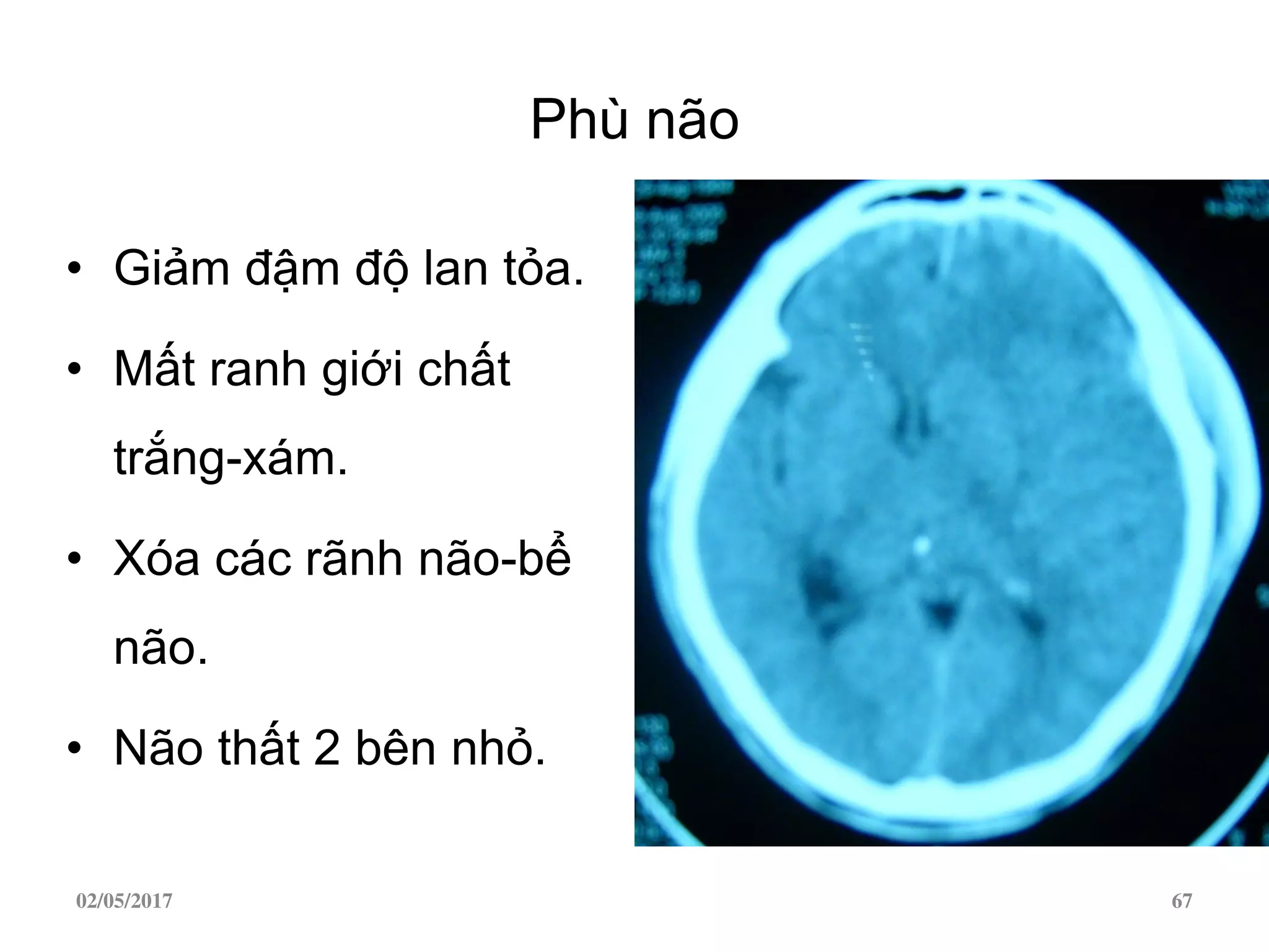 Phù não
• Giảm đậm độ lan tỏa.
• Mất ranh giới chất
trắng-xám.
• Xóa các rãnh não-bể
não.
• Não thất 2 bên nhỏ.
02/05/2017 67
 
