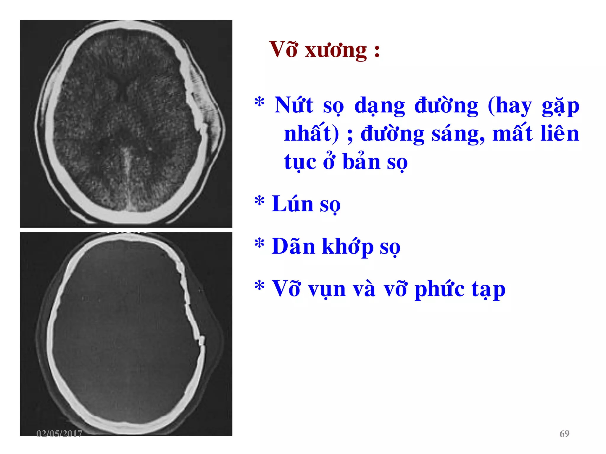 * Nöùt soï daïng ñöôøng (hay gaëp
nhaát) ; ñöôøng saùng, maát lieân
tuïc ôû baûn soï
* Luùn soï
* Daõn khôùp soï
* Vôõ vuïn vaø vôõ phöùc taïp
Vôõ xöông :
02/05/2017 69
 