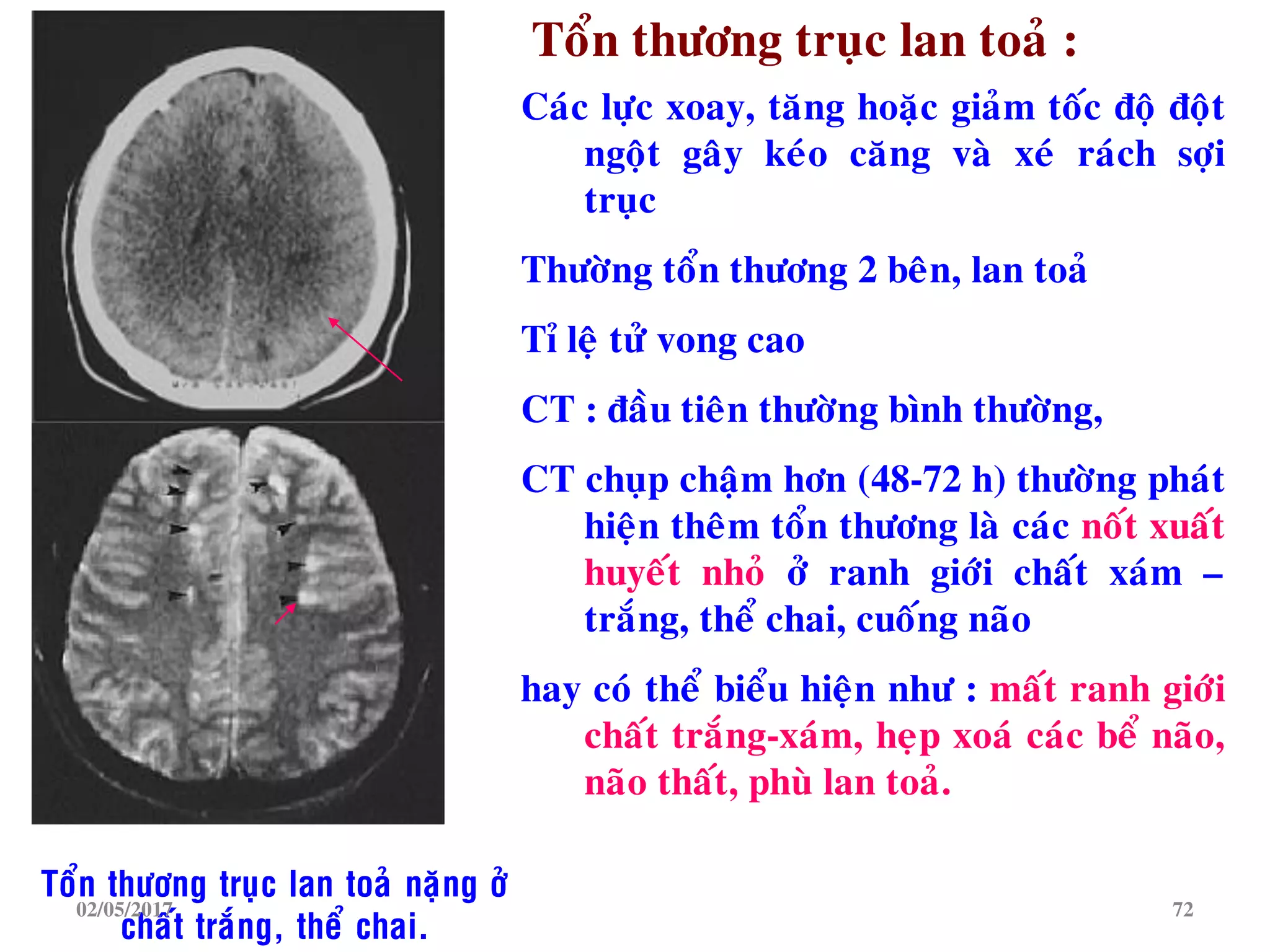 Caùc löïc xoay, taêng hoaëc giaûm toác ñoä ñoät
ngoät gaây keùo caêng vaø xeù raùch sôïi
truïc
Thöôøng toån thöông 2 beân, lan toaû
Tæ leä töû vong cao
CT : ñaàu tieân thöôøng bình thöôøng,
CT chuïp chaäm hôn (48-72 h) thöôøng phaùt
hieän theâm toån thöông laø caùc noát xuaát
huyeát nhoû ôû ranh giôùi chaát xaùm –
traéng, theå chai, cuoáng naõo
hay coù theå bieåu hieän nhö : maát ranh giôùi
chaát traéng-xaùm, heïp xoaù caùc beå naõo,
naõo thaát, phuø lan toaû.
Toån thöông truïc lan toaû :
Toån thöông truïc lan toaû naëng ôû
chaát traéng, theå chai.
02/05/2017 72
 