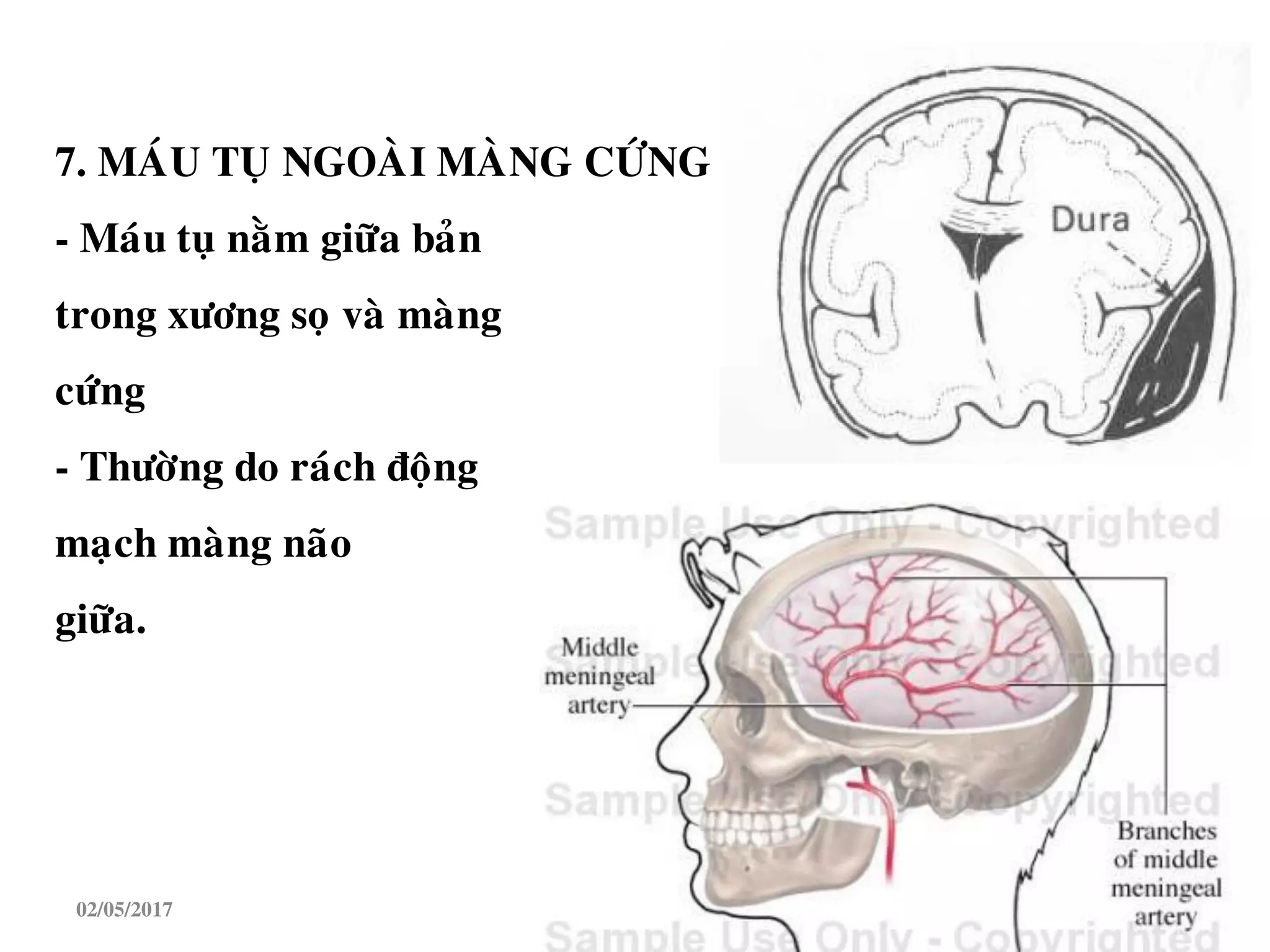 7. MAÙU TUÏ NGOAØI MAØNG CÖÙNG
- Maùu tuï naèm giöõa baûn
trong xöông soï vaø maøng
cöùng
- Thöôøng do raùch ñoäng
maïch maøng naõo
giöõa.
02/05/2017 9
 
