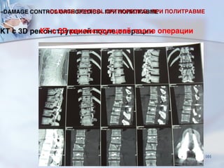КТ с 3D реконструкцией после операции
«DAMAGE CONTROL ORTHOPEDICS» ПРИ ПОЛИТРАВМЕ
101
 