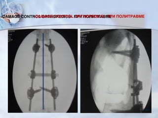 «DAMAGE CONTROL ORTHOPEDICS» ПРИ ПОЛИТРАВМЕ
102
 
