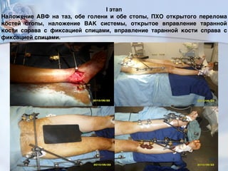I этап
Наложение АВФ на таз, обе голени и обе стопы, ПХО открытого перелома
костей стопы, наложение ВАК системы, открытое вправление таранной
кости справа с фиксацией спицами, вправление таранной кости справа с
фиксацией спицами.
105
 