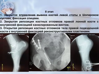 II этап
1. Закрытое вправление вывиха костей левой стопы в Шопаровом
суставе, фиксация спицами.
2. Закрытая репозиция костных отломков правой лонной кости с
внутренней фиксацией канюлированным винтом.
3. Открытая репозиция костных отломков тела правой подвздошной
кости с внутренней фиксацией реконструктивными пластинами.
106
 