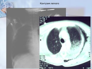 Контузия легкого
45
 