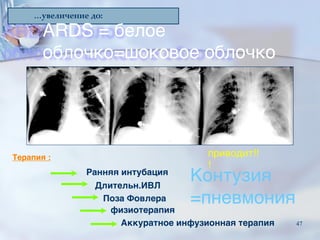 …увеличение до:
ARDS = белое
облочко=шоковое облочко
Терапия :
Ранняя интубация
Длительн.ИВЛ
Поза Фовлера
физиотерапия
Аккуратное инфузионная терапия
приводит!!
!
Контузия
=пневмония
47
 
