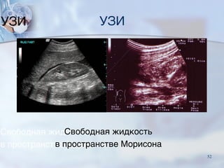 УЗИ
Свободная жидкость
в пространстве Морисона
52
 