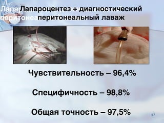 57
Лапароцентез + диагностический
перитонеальный лаваж  
Чувствительность – 96,4%
Специфичность – 98,8% 
Общая точность – 97,5%
 