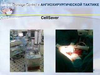 64
CellSaver
Damage Control в АНГИОХИРУРГИЧЕСКОЙ ТАКТИКЕ
 