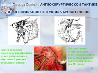 Доступ к нижней
полой вене производится
путем мобилизации и
внутренней ротации
восходящей кишки
Доступ к аорте
осуществляется
путем мобилизации и
внутренней ротации
нисходящей кишки
(по Мэттоксу)
ИДЕНТИФИКАЦИЯ ИСТОЧНИКА КРОВОТЕЧЕНИЯ
Damage Control в АНГИОХИРУРГИЧЕСКОЙ ТАКТИКЕ
65
 