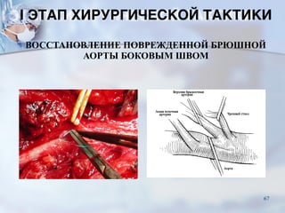 ВОССТАНОВЛЕНИЕ ПОВРЕЖДЕННОЙ БРЮШНОЙ
АОРТЫ БОКОВЫМ ШВОМ
I ЭТАП ХИРУРГИЧЕСКОЙ ТАКТИКИ
67
 