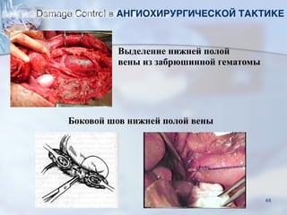 Выделение нижней полой
вены из забрюшинной гематомы
Боковой шов нижней полой вены
Damage Control в АНГИОХИРУРГИЧЕСКОЙ ТАКТИКЕ
68
 