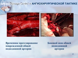 Временное протезирование
поврежденной общей
подвздошной артерии
Боковой шов общей
подвздошной
артерии
Damage Control в АНГИОХИРУРГИЧЕСКОЙ ТАКТИКЕ
69
 