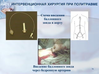Схема введения
баллонного
зонда в аорту
Введение баллонного зонда
через бедренную артерию
ИНТЕРВЕНЦИОННАЯ ХИРУРГИЯ ПРИ ПОЛИТРАВМЕ
70
 