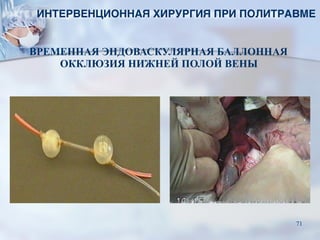 ВРЕМЕННАЯ ЭНДОВАСКУЛЯРНАЯ БАЛЛОННАЯ
ОККЛЮЗИЯ НИЖНЕЙ ПОЛОЙ ВЕНЫ
ИНТЕРВЕНЦИОННАЯ ХИРУРГИЯ ПРИ ПОЛИТРАВМЕ
71
 