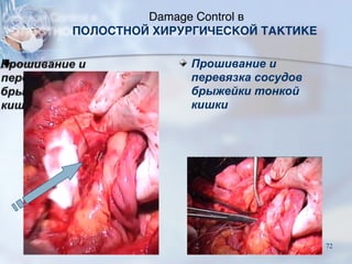Прошивание и
перевязка сосудов
брыжейки тонкой
кишки
Damage Control в
ПОЛОСТНОЙ ХИРУРГИЧЕСКОЙ ТАКТИКЕ
72
 