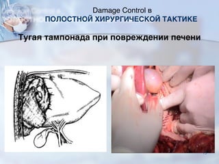 Тугая тампонада при повреждении печени
Damage Control в
ПОЛОСТНОЙ ХИРУРГИЧЕСКОЙ ТАКТИКЕ
73
 