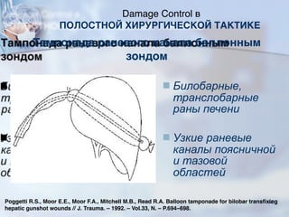 Тампонада раневого канала баллонным
зондом
■ Билобарные,
транслобарные
раны печени
■ Узкие раневые
каналы поясничной
и тазовой
областей
Poggetti R.S., Moor E.E., Moor F.A., Mitchell M.B., Read R.A. Balloon tamponade for bilobar transfixing
hepatic gunshot wounds // J. Trauma. – 1992. – Vol.33, N. – P.694–698.
Damage Control в
ПОЛОСТНОЙ ХИРУРГИЧЕСКОЙ ТАКТИКЕ
74
 