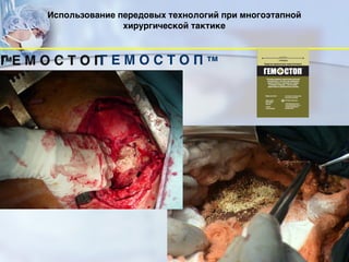 75
Г Е М О С Т О П тм
Использование передовых технологий при многоэтапной
хирургической тактике 
 